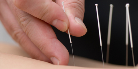 acupuncture treatment, northstar natural